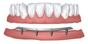 Bar Retained Dentures