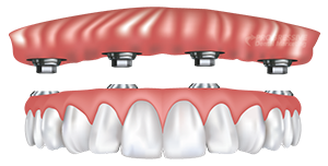 Ball Retained Dentures